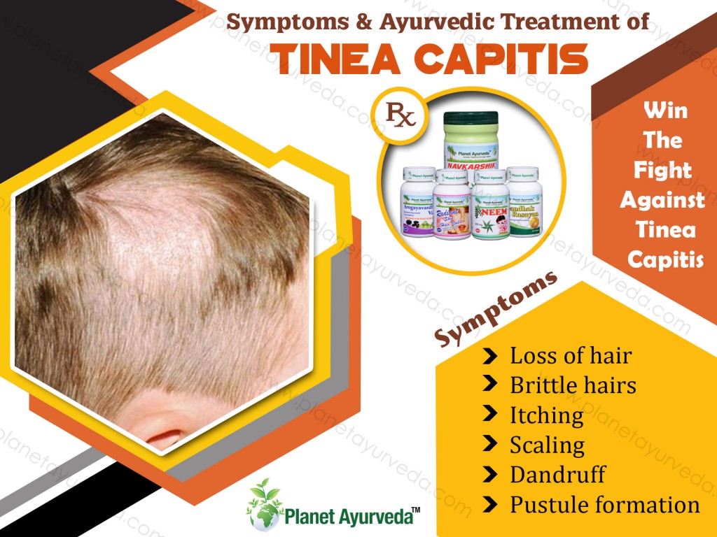 Treatment Of Tinea Capitis With Herbal Remedies 0224