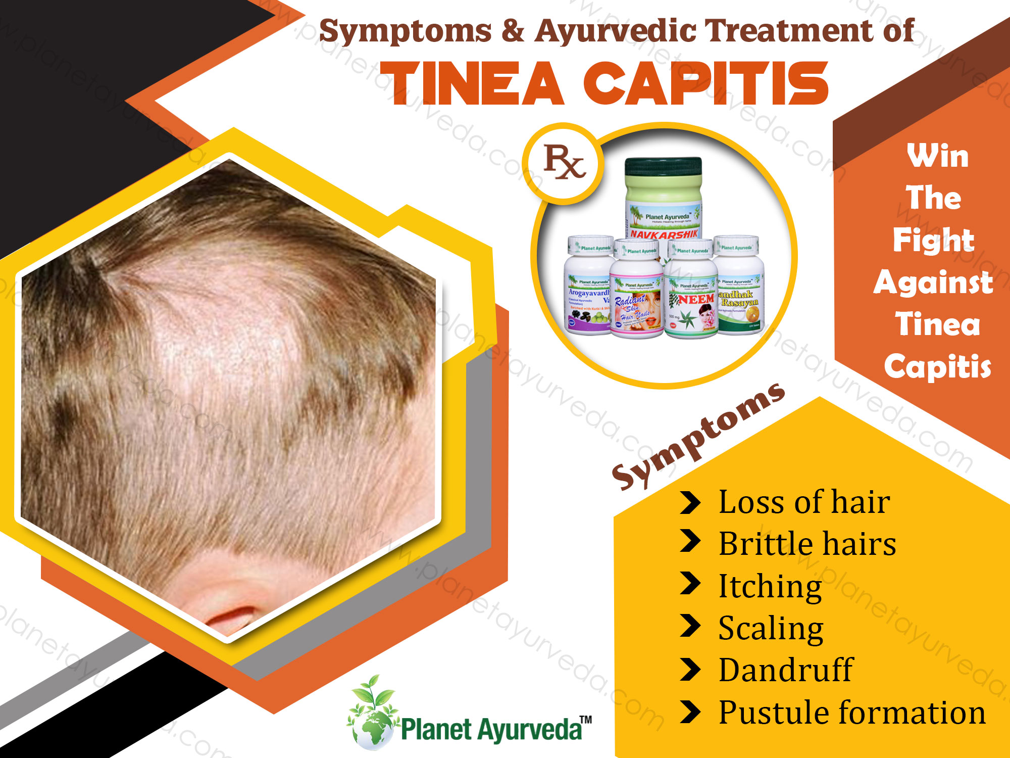 Treatment Of Tinea Capitis With Herbal Remedies