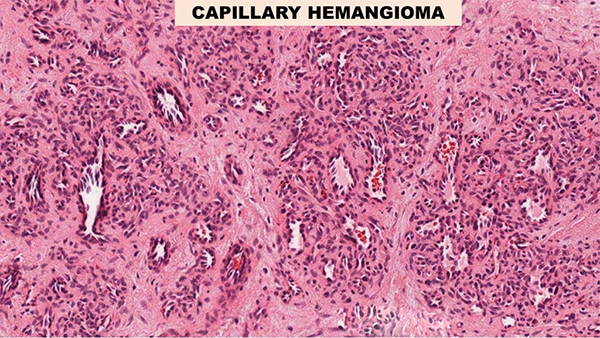 Capillary Hemangioma