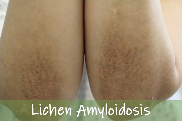 Lichen  Amyloidosis
