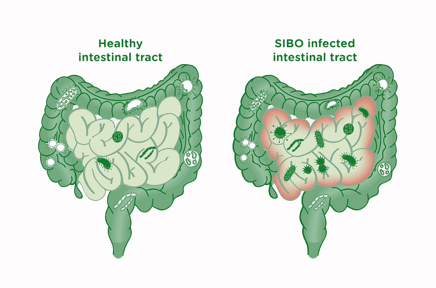 small-intestinal-bacterial-overgrowth