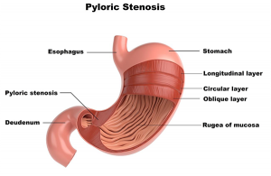 Ayurvedic Treatment Of Pyloric Stenosis