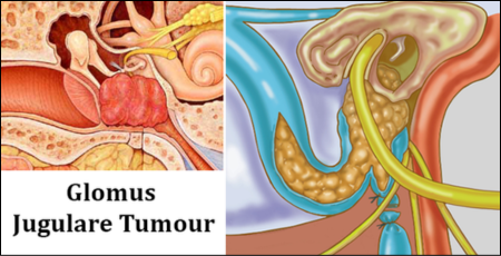 Glomus Jugulare Tumour