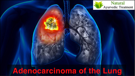 Adenocarcinoma Of Lung