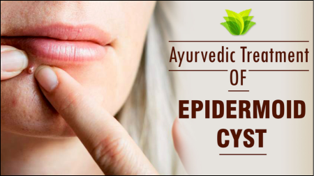 Epidermoid Cysts