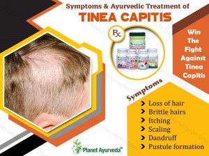 Treatment of Tinea Capitis with Herbal Remedies