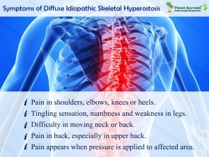 Ayurvedic Treatment of Diffuse Idiopathic Skeletal Hyperostosis