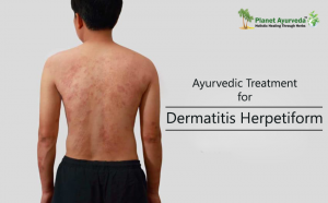 Treatment Of Dermatitis Herpetiform With Herbal Remedies