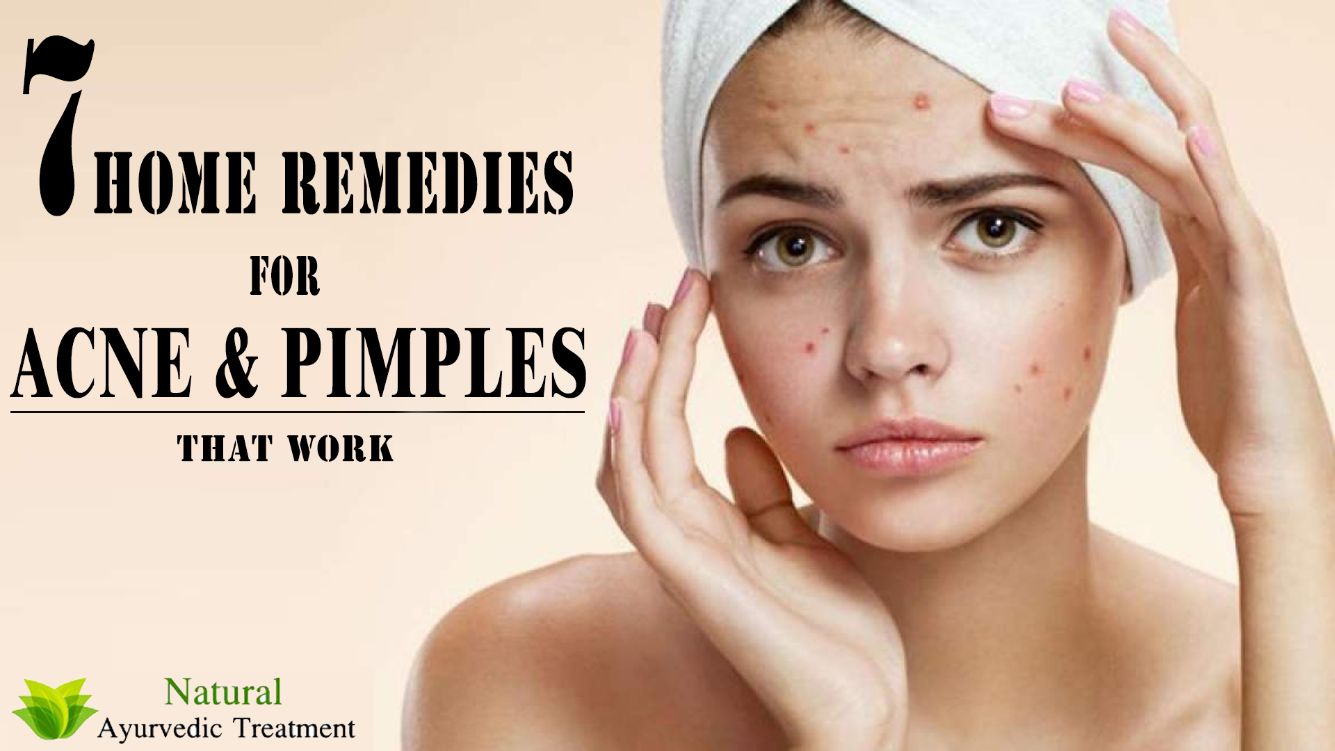 7 Home Remedies for Acne & Pimples that Work