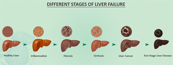 Meld And Model Of End Stage Liver Disease And Its Ayurvedic Treatment