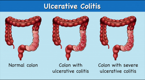 How is Ayurveda Combating the Increasing Problem of Ulcerative Colitis?