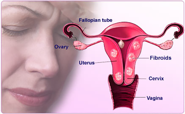 Ayurvedic Treatment for Uterine Fibroid