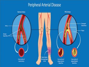 Natural Remedies For PAD Disease In Ayurveda