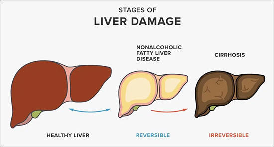 Fatty Liver - Ayurvedic Treatment