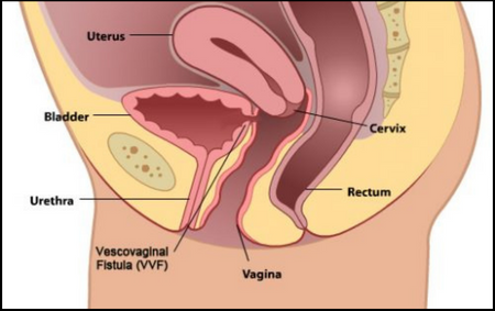 Ureterovaginal Fistula