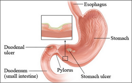 Duodenal Ulcers