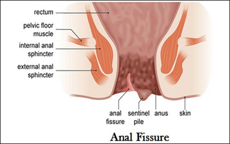 Anal Fistual or Fissure